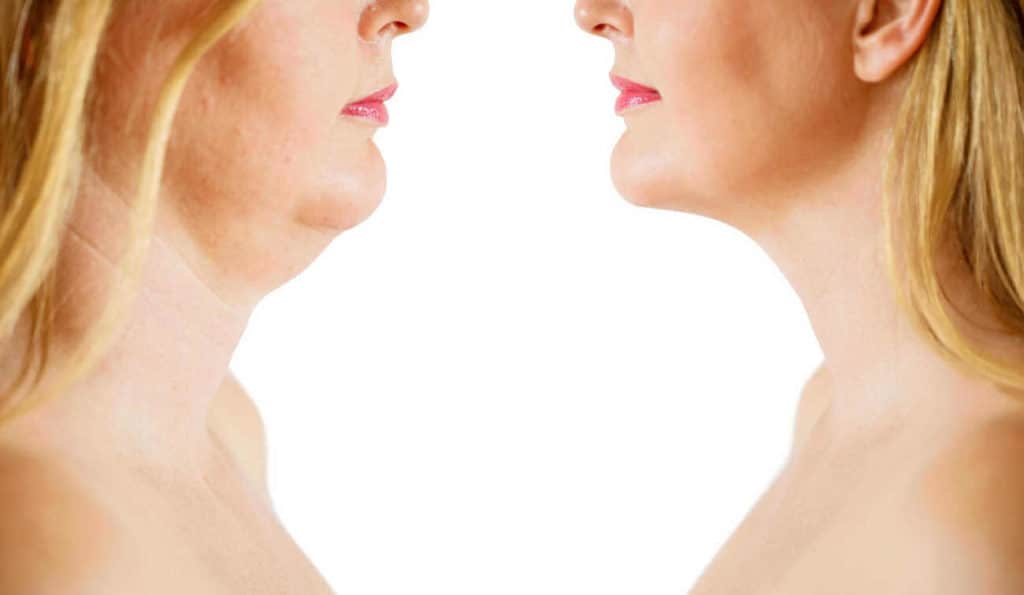 Double Chin treatment Leytonstone before and after results