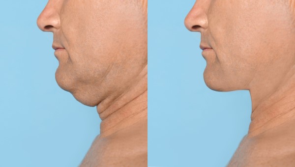 Which Non-Surgical Treatments Work Best for Jowls and Loose Skin Leytonstone?