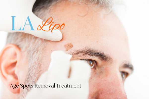 What Are the Most Effective Treatments for Age Spots Leytonstone?
