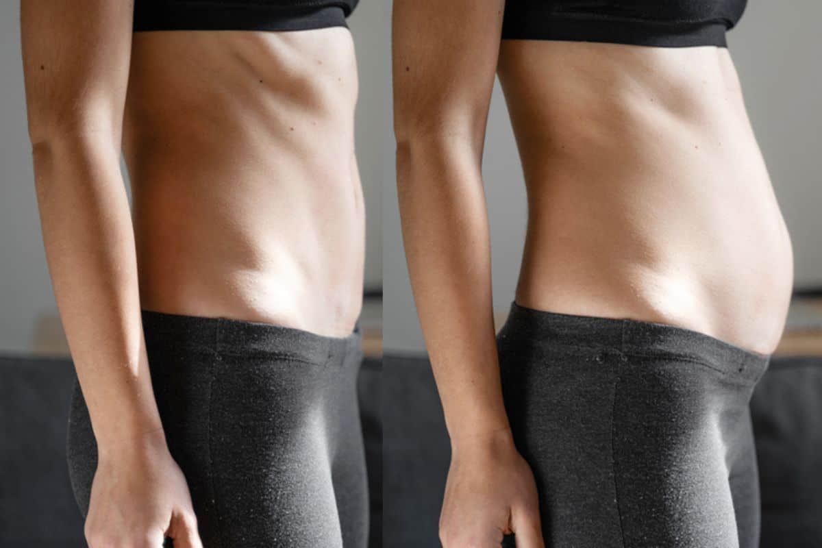 How long does diastasis recti take to improve Leytonstone?