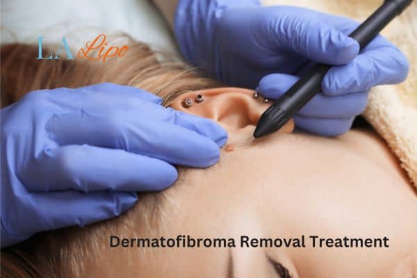 Dermatofibroma Removal Treatment Leytonstone