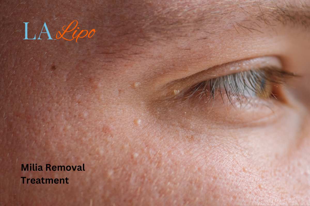 Cryopen Milia Removal: Is It the Easiest and Safest Option Leytonstone?