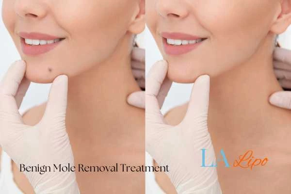 woman's before and after mole removal Leytonstone results