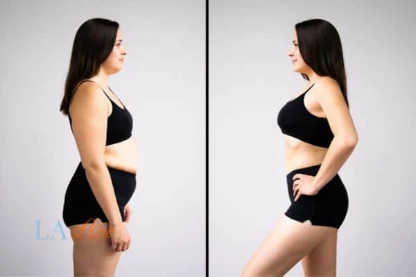 image of woman before and after results of LA-EMS Body Sculpting Leytonstone to help treat Diastasis recti