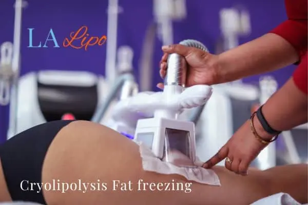 women getting fat freezing Leytonstone