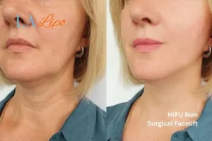 hi-fu for wrinkles Leytonstone before and after results