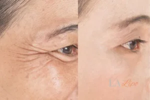 Before and after results of woman - HI-fu wrinkles reduction treatment Leytonstone