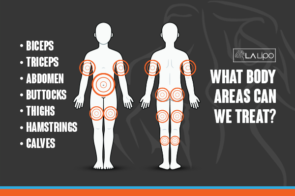 Graphic to show areas you can have LA-EMS Body Sculpting Leytonstone treatment.