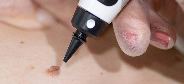 skin tag removal using cryopen Leytonstone