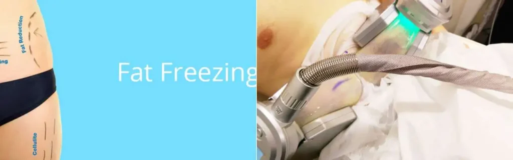 Fat freezing Leytonstone on multiple areas of the body
