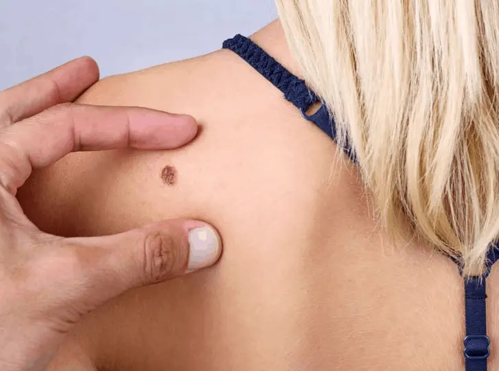 woman having mole removal Leytonstone consultation before treatment.