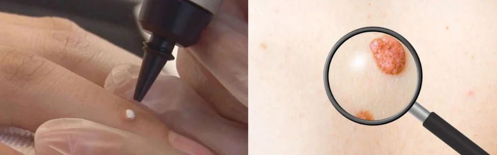 CryoPen practitioner Leytonstone assessing a benign mole before treatment