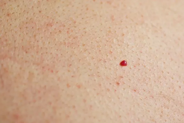 close up of a cherry angioma Leytonstone