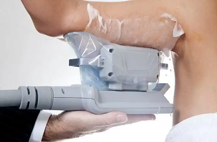 Picture of fat freezing Leytonstone on the upper arms.