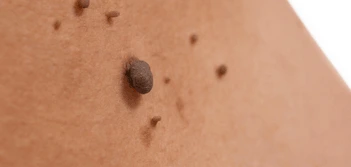 image of a skin tag Leytonstone