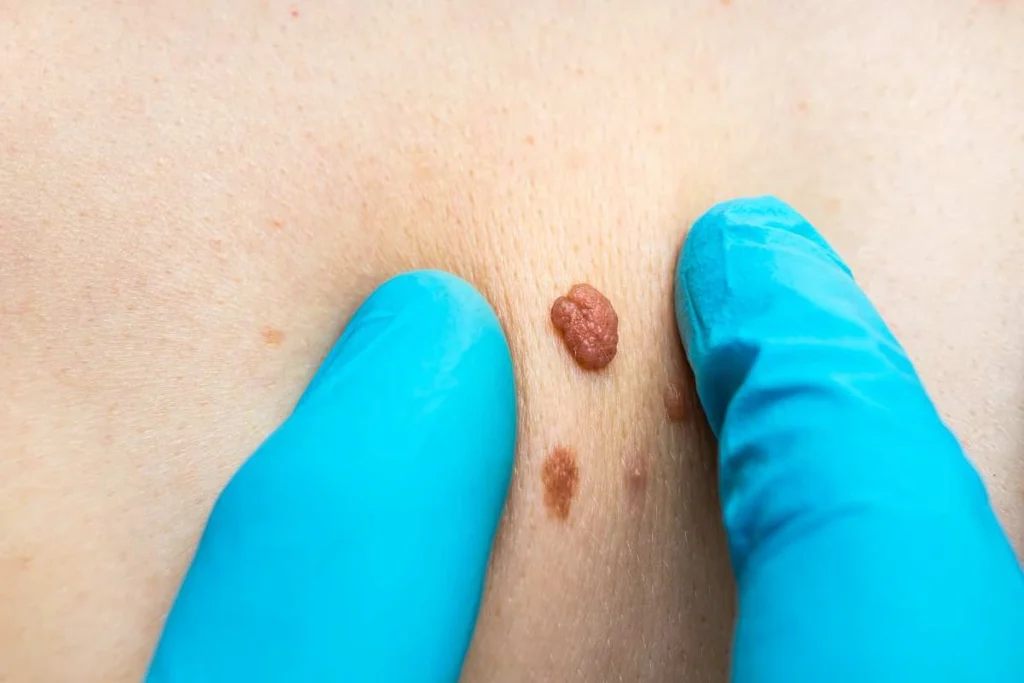 Consultant examining a skin tag Leytonstone