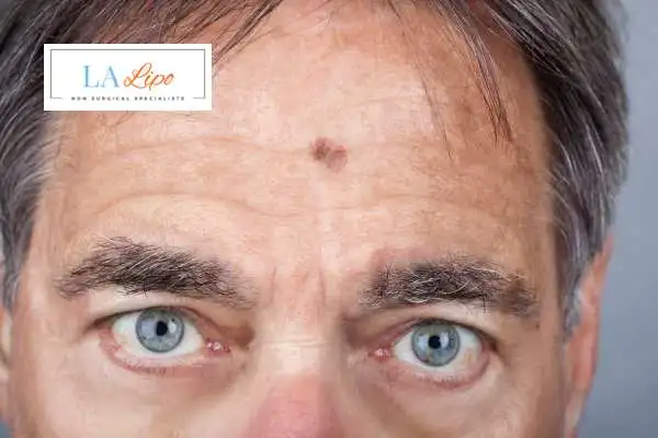 Solar Lentigo Removal Leytonstone image of man with mark on his forehead