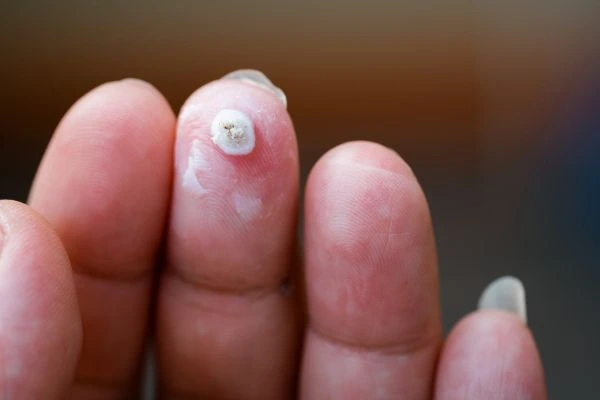 wart on person finger - cryotherapy to treat from LA LIPO Leytonstone