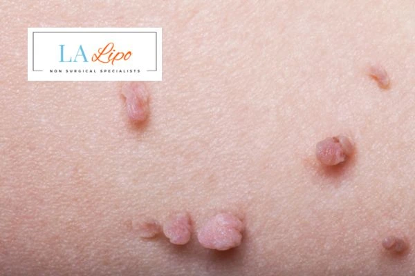 Does cryopen skin tag removal Leytonstone hurt? Find out now call our team today!