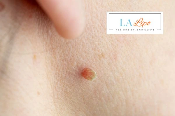 Book skin tag removal Leytonstone today speak to our team now!