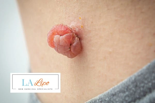 Interested in skin tag removal Leytonstone? Concerned about the pain? Find out more today!