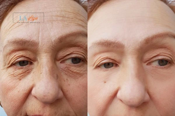 The powerful benefits of Morpheus8 Treatment Leytonstone - Call Our team today!