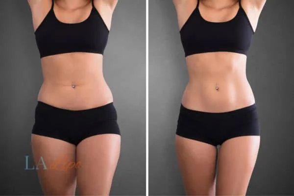 before and after results of non-surgical treatment to help a woman's body image and mental health Leytonstone