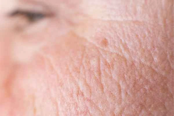 close up picture of a woman's face showing an age spot Leytonstone