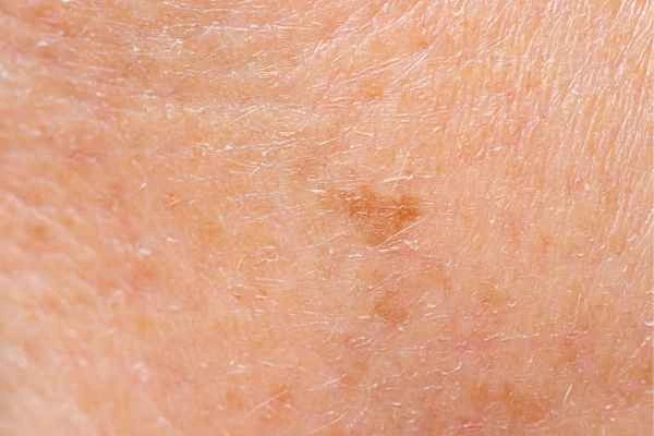 close up picture of age spots Leytonstone