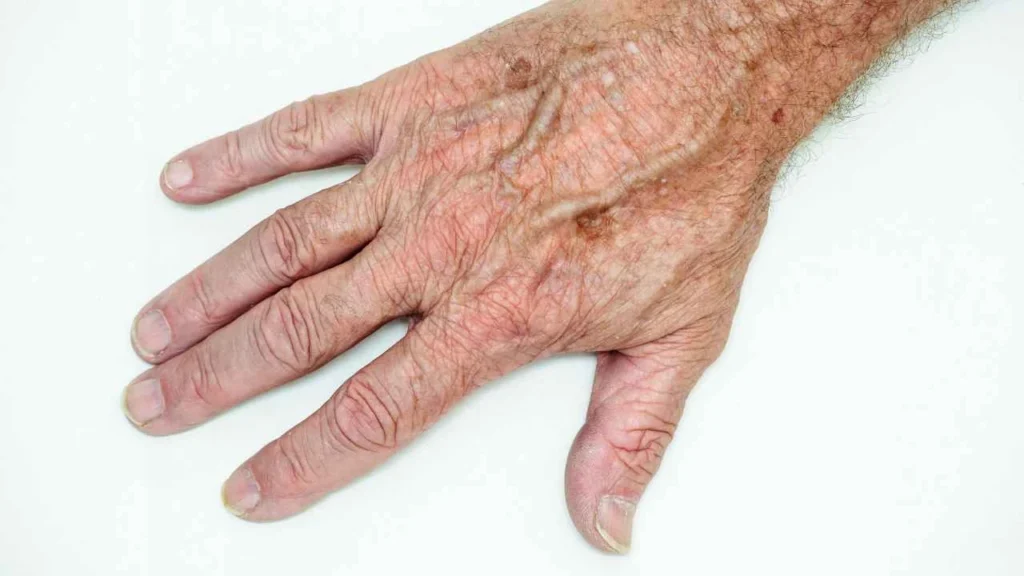 Male hand showing age spot Leytonstone