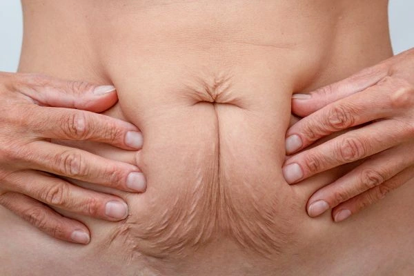 Should I Combine Diastasis Recti Treatment with Body Contouring for Better Results Leytonstone?