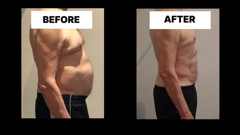 What Symptoms Can Diastasis Recti Cause in Men? Weak Core, Back Pain and Poor Posture Leytonstone